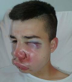 Le jeune Sofiane 16 ans, a ete victime d'un tir de flash-ball, dimanche soir a Compiegne affirme sa famille
