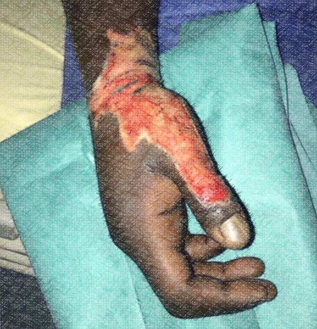 Abdoulaye, agressé par la police à Mantes la Jolie le 7 novembre 2017
